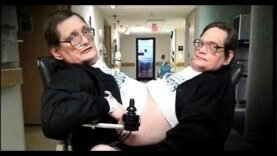 Siamese twins in vicious legal battle over right to masturbate?