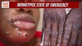 Monkeypox State Of Emergency Declared In CA, NY, IL. Here’s What You Need To Know About The Virus